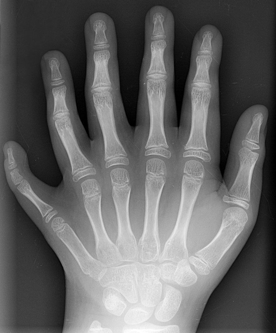 Polydactyly_01_Lhand_AP